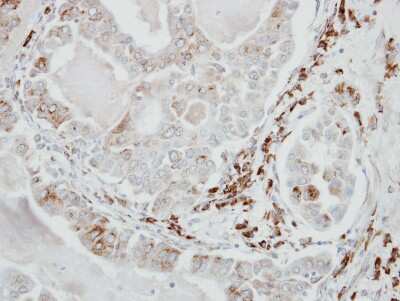 Immunohistochemistry-Paraffin: VDP p115 Antibody [NBP2-17245] - Immunohistochemical analysis of paraffin-embedded lung AdCA, using antibody at 1:500 dilution.