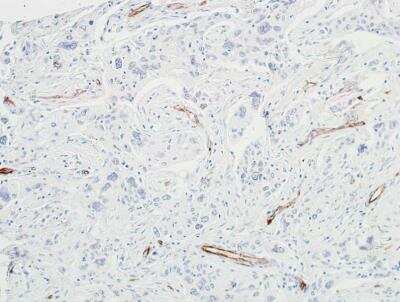 Immunohistochemistry: VE-Cadherin Antibody (BLR091G) [NBP2-80140] - Detection of human VE-Cadherin in FFPE breast carcinoma by IHC. Antibody: Rabbit anti-VE-Cadherin recombinant monoclonal [BLR091G] (NBP2-80140). Secondary: HRP-conjugated goat anti-rabbit IgG. Substrate: DAB.