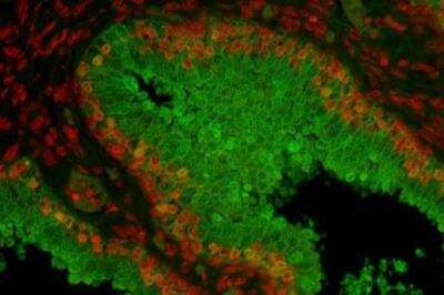 Immunohistochemistry: VECTASHIELD(R) Hardset(TM) Antifade Mounting Medium [H-1400-NB] - Prostate Specific Antigen (rp), fluorescein labeled using the ProtOn Fluorescein Labeling Kit. Propidium Iodide counterstain (red). Mounted in VECTASHIELD HardSet Mounting Medium.