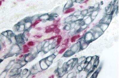 Immunohistochemistry: VECTASTAIN(R) ABC anti-mouse/rabbit AP Immunodetection Kit [AK-5200-NB] - Colon Carcinoma (double label): S100 (rp), VECTASTAIN Universal ABC-AP Kit, Vector Red substrate (red); Cytokeratin 8/18 (m), VECTASTAIN Universal Elite ABC Kit, Vector SG substrate (blue/gray).