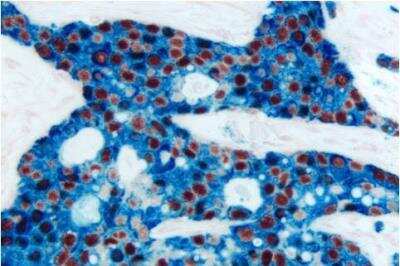 Immunohistochemistry: VECTASTAIN(R) ABC anti-mouse/rabbit AP Immunodetection Kit [AK-5200-NB] - Breast Carcinoma (double label): Estrogen Receptor (m), ImmPRESS Universal Reagent, Vector NovaRED substrate (red); Cytokeratin 8/18 (m), VECTASTAIN Universal ABC-AP Kit, Vector Blue substrate (blue)