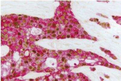 Immunohistochemistry: VECTASTAIN(R) ABC anti-mouse/rabbit AP Immunodetection Kit [AK-5200-NB] - Breast Carcinoma (double label): Estrogen Receptor (m), ImmPRESS Universal Reagent, Vector DAB substrate (brown); Multi-Cytokeratin (m), VECTASTAIN Universal ABC-AP Kit, Vector Red substrate (red)