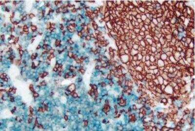 Immunohistochemistry: VECTASTAIN(R) ABC anti-mouse/rabbit AP Immunodetection Kit [AK-5200-NB] - Tonsil (double label): CD3 (m), VECTASTAIN Universal ABC-AP Kit, Vector Blue substrate (blue); CD20 (m), ImmPRESS Universal Reagent, Vector NovaRED substrate (red).