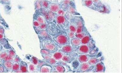 Immunohistochemistry: VECTASTAIN(R) ABC anti-mouse/rabbit AP Immunodetection Kit [AK-5200-NB] - Tumor (double label): p53 protein (m), VECTASTAIN ABC-AP Kit, Vector Red substrate (red); Pan-Cytokeratin (m), VECTASTAIN Elite ABC Kit, Vector SG Substrate (blue/gray).