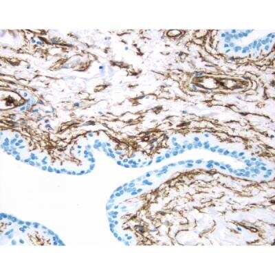 Immunohistochemistry: VECTASTAIN(R) ELITE(R) ABC anti-Mouse IgG HRP Immunodetection Kit [PK-6102-NB] - Breast Cancer: CD34 antigen stained using VECTASTAIN Elite ABC Kit and Vector DAB (brown) substrate. Hematoxylin QS (blue) counterstain.