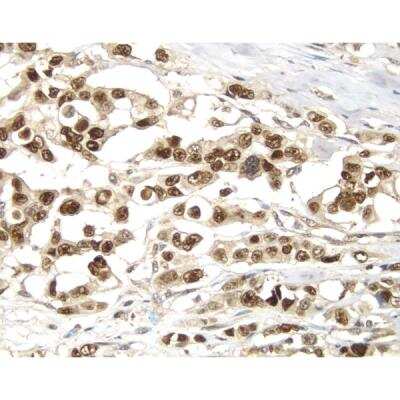 Immunohistochemistry: VECTASTAIN(R) ELITE(R) ABC anti-Rabbit IgG HRP Immunodetection Kit [PK-6101-NB] - Breast Cancer: p53 protein stained using VECTASTAIN Elite ABC Kit and Vector DAB (brown) substrate. Hematoxylin QS (blue) counterstain.