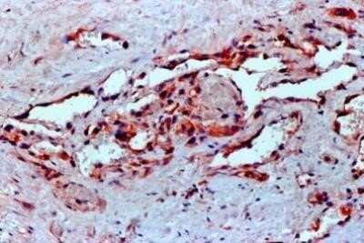 FFPE human angiosarcoma tissue section using VEGF antibody (clone VG1). The endothelial cells of the blood vessels and most of the cancer cells showed strong positivity for VEGF protein. Image from the standard format of this antibody.