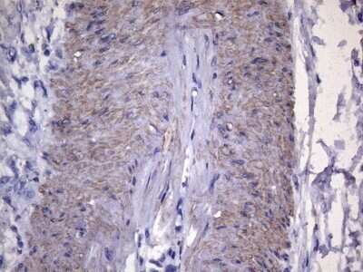 Immunohistochemistry: VEGF-C Antibody (OTI4A1) - Azide and BSA Free [NBP2-74845] - Staining of paraffin-embedded Carcinoma of Human pancreas tissue using anti-VEGFC mouse monoclonal antibody. (Heat-induced epitope retrieval by 1mM EDTA in 10mM Tris buffer (pH8.5) at 120C for 3min) (1:150)