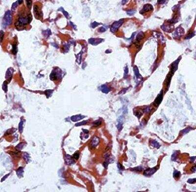 Immunohistochemistry: VEGF R1/Flt-1 Antibody [NB100-685] - Formalin fixed paraffin embedded human angiosarcoma stained with Flt-1.