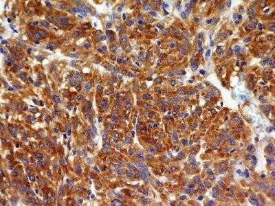 Immunohistochemistry-Paraffin: VEGFR2/KDR/Flk-1 Antibody (1B6) - Azide and BSA Free [NBP2-81008] - Analysis of FFPE tissue section of a malignant stromal tumor of the human small bowel with mouse monoclonal VEGF R2/KDR/Flk-1 antibody (clone 1B6) at 5 ug/ml concentration. The cancer cells depicted a specific and strong staining in the cytoplasm. Image f