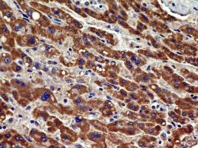 Immunohistochemistry-Paraffin: VEGFR2/KDR/Flk-1 Antibody (1B6) - Azide and BSA Free [NBP2-81008] - Analysis of FFPE tissue section of human liver cancer with mouse monoclonal VEGF R2/KDR/Flk-1 antibody (clone 1B6) at 5 ug/ml concentration. The cancer cells showed a specific and strong staining in the cytoplasm. Image from the standard format of this an