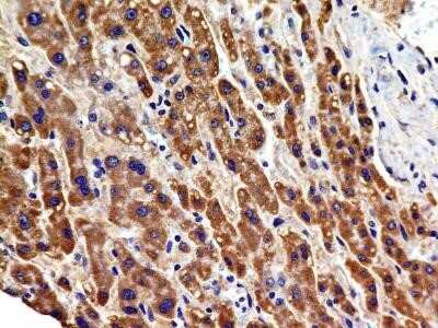 Immunocytochemistry: VEGFR2/KDR/Flk-1 Antibody (2C6) - Azide and BSA Free [NBP2-81009] - Analysis of FFPE tissue section of Human Hepatocellular Carcinoma with antibody at 5 ug/ml concentration. The cancer cells depicted a specific and strong staining in the cytoplasm. Image from the standard format of this antibody.