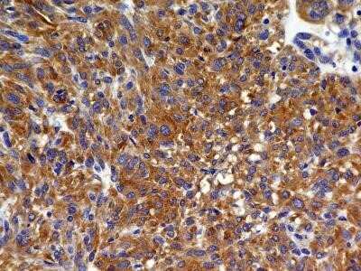 Immunohistochemistry: VEGFR2/KDR/Flk-1 Antibody (2C6) - Azide and BSA Free [NBP2-81009] - Analysis of FFPE tissue section of a malignant stromal tumor of the human small bowel with antibody at 5 ug/ml concentration. The cancer cells depicted a specific and strong staining in the cytoplasm. Image from the standard format of this antibody.