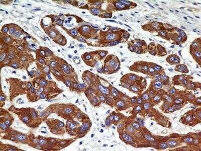 Immunohistochemistry-Paraffin: VEGFR2/KDR/Flk-1 Antibody (2C6) - Azide and BSA Free [NBP2-81009] - Analysis of FFPE tissue section of Human SCC of Esophagus with antibody at 5 ug/ml concentration. The cancer cells depicted a specific and strong staining in the cytoplasm while the tumor stroma was negative for VEGF R2/KDR/Flk-1 immunopositivity. Image f