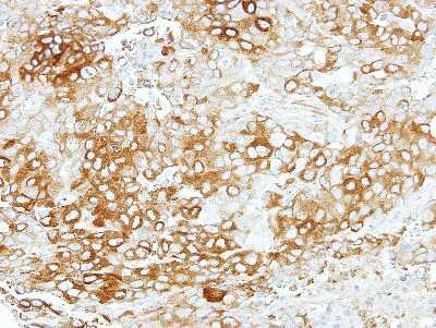 Immunohistochemistry-Paraffin: VEZT Antibody [NBP2-20856] - Immunohistochemical analysis of paraffin-embedded BT474 xenograft, using antibody at 1:500 dilution.