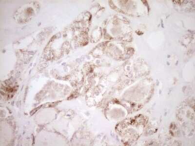 Immunohistochemistry: VIP Antibody (1E8) [NBP2-46349] - Analysis of Carcinoma of Human thyroid tissue. (Heat-induced epitope retrieval by 1 mM EDTA in 10mM Tris, pH8.5, 120C for 3min)