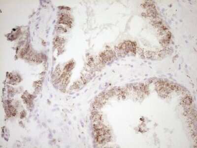 Immunohistochemistry: VIP Antibody (OTI1E8) - Azide and BSA Free [NBP2-74848] - Analysis of Adenocarcinoma of Human endometrium tissue. (Heat-induced epitope retrieval by 1 mM EDTA in 10mM Tris, pH8.5, 120C for 3min)