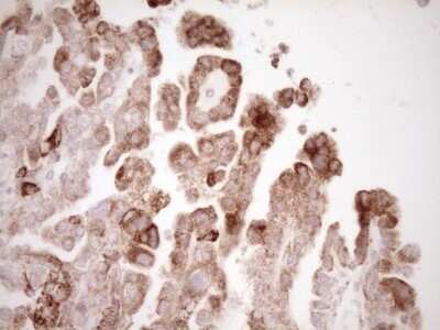 Immunohistochemistry: VIP Antibody (OTI1E8) - Azide and BSA Free [NBP2-74848] - Analysis of Adenocarcinoma of Human ovary tissue. (Heat-induced epitope retrieval by 1 mM EDTA in 10mM Tris, pH8.5, 120C for 3min)