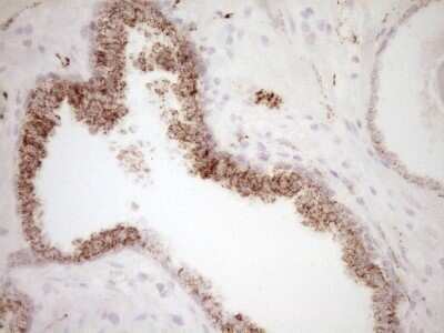 Immunohistochemistry: VIP Antibody (OTI1E8) - Azide and BSA Free [NBP2-74848] - Analysis of Carcinoma of Human prostate tissue. (Heat-induced epitope retrieval by 1 mM EDTA in 10mM Tris, pH8.5, 120C for 3min)