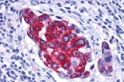 Immunohistochemistry-Paraffin: VIP R2/VPAC2 Antibody [NLS1305] - Anti-VPAC2 / VIPR2 antibody IHC of human Breast, Carcinoma. Immunohistochemistry of formalin-fixed, paraffin-embedded tissue after heat-induced antigen retrieval.