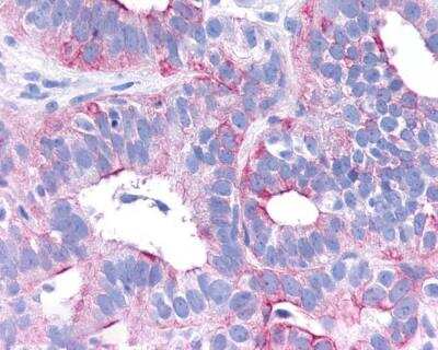 Immunohistochemistry-Paraffin: VIP R2/VPAC2 Antibody [NLS1305] - Anti-VPAC2 / VIPR2 antibody IHC of human Ovary, Carcinoma. Immunohistochemistry of formalin-fixed, paraffin-embedded tissue after heat-induced antigen retrieval.