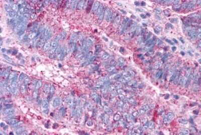 Immunohistochemistry-Paraffin: VIP R2/VPAC2 Antibody [NLS1306] - Anti-VPAC2 / VIPR2 antibody IHC of human Colon, Carcinoma. Immunohistochemistry of formalin-fixed, paraffin-embedded tissue after heat-induced antigen retrieval.