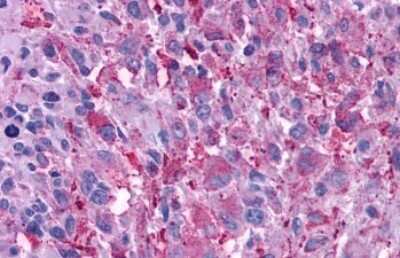 Immunohistochemistry-Paraffin: VIP R2/VPAC2 Antibody [NLS1306] - Anti-VPAC2 / VIPR2 antibody IHC of human Brain, Glioblastoma. Immunohistochemistry of formalin-fixed, paraffin-embedded tissue after heat-induced antigen retrieval.