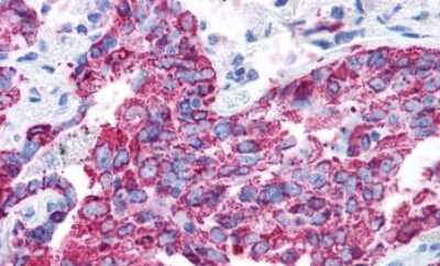 Immunohistochemistry-Paraffin: VIP R2/VPAC2 Antibody [NLS1306] - Anti-VPAC2 / VIPR2 antibody IHC of human Lung, Adenocarcinoma. Immunohistochemistry of formalin-fixed, paraffin-embedded tissue after heat-induced antigen retrieval.