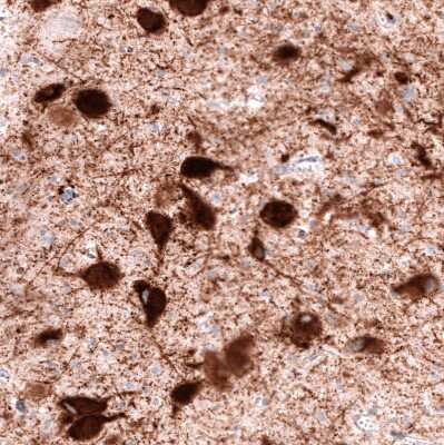 Immunohistochemistry-Paraffin: VMAT2 Antibody (CL12531) [NBP3-18570] - Staining of human dorsal raphe nucleus shows strong cytoplasmic positivity in neurons.