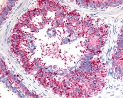 Immunohistochemistry-Paraffin: VN1R1 Antibody [NLS3462] - Analysis of anti-V1RL1 / VN1R1 antibody with human breast, carcinoma.