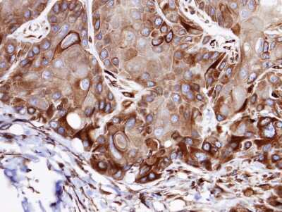 Immunohistochemistry-Paraffin: VPS16 Antibody [NBP1-31455] - Paraffin-embedded SCC15 xenograft, using antibody at 1:100 dilution.