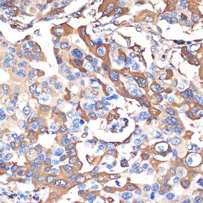 Immunohistochemistry-Paraffin: VPS28 Antibody (4F8M0) [NBP3-15703] - Immunohistochemistry of paraffin-embedded human lung cancer using VPS28 Rabbit mAb (NBP3-15703) at dilution of 1:100 (40x lens).Perform microwave antigen retrieval with 10 mM Tris/EDTA buffer pH 9.0 before commencing with IHC staining protocol.