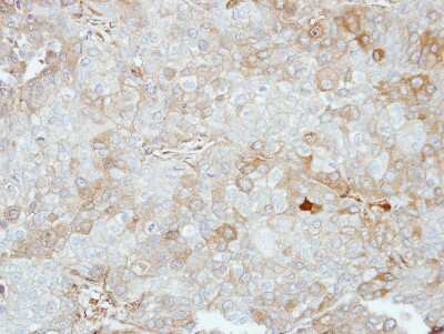 Immunohistochemistry-Paraffin: VPS28 Antibody [NBP2-20870] - Immunohistochemical analysis of paraffin-embedded BT474 xenograft, using antibody at 1:500 dilution.