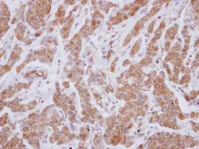 Immunohistochemistry-Paraffin: VPS29 Antibody [NBP2-20871] -  Human breast cancer, using VPS29 antibody at 1:250 dilution.Antigen Retrieval: Trilogy™ (EDTA based, pH 8.0) buffer, 15 min.