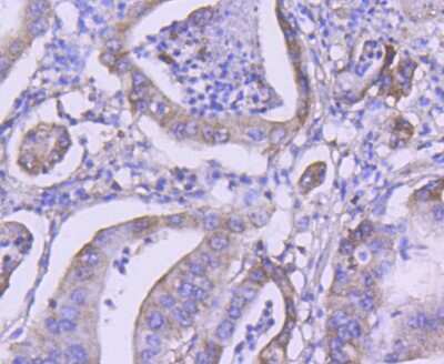 Immunohistochemistry-Paraffin: VPS34 Antibody (SY0286) [NBP2-67450] - Analysis of paraffin-embedded human gastric carcinoma tissue using anti-PI 3 Kinase Class 3 antibody. Counter stained with hematoxylin.