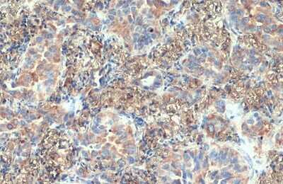 Immunohistochemistry-Paraffin: VPS35 Antibody (HL1017) [NBP3-13680] - VPS35 antibody [HL1017] detects VPS35 protein at cytoplasm by immunohistochemical analysis. Sample: Paraffin-embedded human lung cancer. VPS35 stained by VPS35 antibody [HL1017] (NBP3-13680) diluted at 1:50. Antigen Retrieval: Citrate buffer, pH 6.0, 15 min