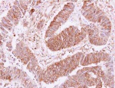 Immunohistochemistry-Paraffin: VPS35 Antibody [NBP1-31069] - VPS35 antibody [C3], C-term detects VPS35 protein at cytoplasm and membrane on human colon carcinoma by immunohistochemical analysis. Sample: Paraffin-embedded colon carcinoma. VPS35 antibody [C3], C-term  dilution: 1:250.