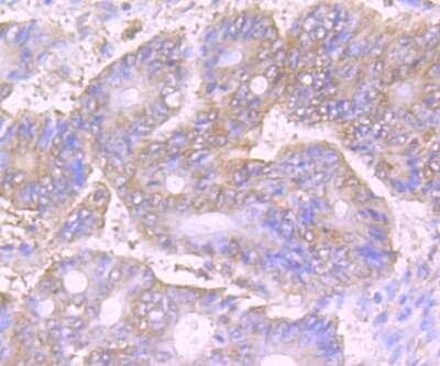 Immunohistochemistry-Paraffin: VPS35 Antibody (JB33-82) [NBP2-75710] - Analysis of paraffin-embedded human colon cancer tissue using anti-VPS35 antibody. Counter stained with hematoxylin.