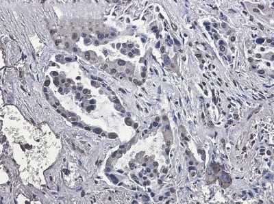 Immunohistochemistry-Paraffin: VPS35 Antibody (S03-6E1) [NBP3-19926] - Immunohistochemistry of VPS35 in paraffin-embedded Human lung cancer tissue using NBP3-19926 at dilution 1/50