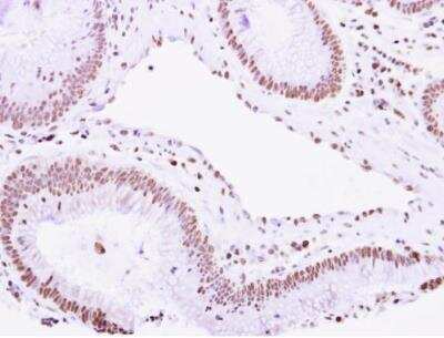 Immunohistochemistry-Paraffin: VPS4B Antibody [NBP2-20881] - Colon carcinoma. VPS4B antibody [N3C3] dilution: 1:500. Antigen Retrieval: Trilogy™ (EDTA based, pH 8.0) buffer, 15min .