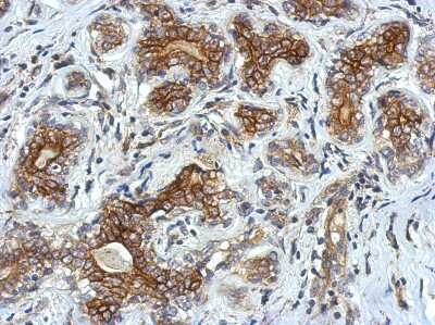 Immunohistochemistry-Paraffin: VSIG1 Antibody [NBP2-20883] - Immunohistochemical analysis of paraffin-embedded Breast ca, using antibody at 1:500 dilution.