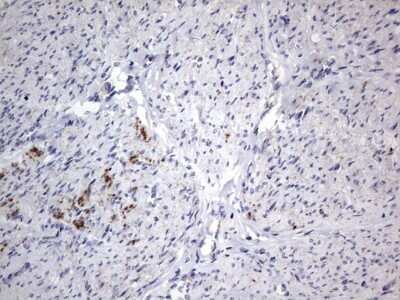 Immunohistochemistry: VSIG3/IGSF11 Antibody (OTI2H1) - Azide and BSA Free [NBP2-74861] - Analysis of Adenocarcinoma of Human endometrium tissue.