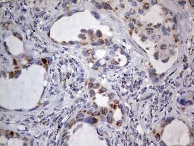 Immunohistochemistry: VSIG3/IGSF11 Antibody (OTI2H1) - Azide and BSA Free [NBP2-74861] - Analysis of Carcinoma of Human lung tissue using IGSF11 mouse monoclonal antibody. Dilution: 1:150