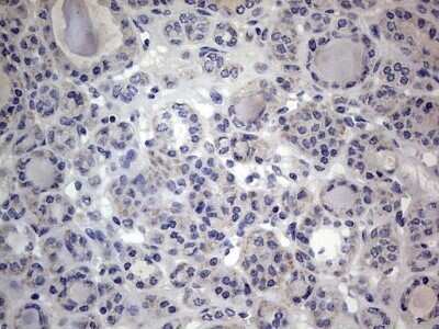 Immunohistochemistry: VSIG3/IGSF11 Antibody (OTI2H1) - Azide and BSA Free [NBP2-74861] - Analysis of Carcinoma of Human thyroid tissue.