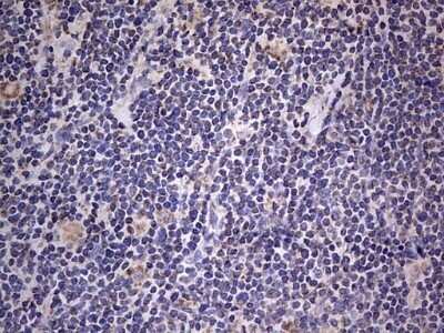 Immunohistochemistry: VSIG3/IGSF11 Antibody (OTI2H1) - Azide and BSA Free [NBP2-74861] - Analysis of Human lymphoma tissue.