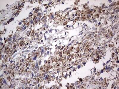 Immunohistochemistry: VSIG3/IGSF11 Antibody (OTI2H1) [NBP2-46046] - Analysis of Adenocarcinoma of Human ovary tissue.