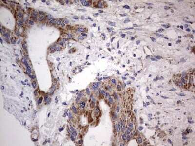 Immunohistochemistry: VSIG3/IGSF11 Antibody (OTI2H1) [NBP2-46046] - Analysis of Carcinoma of Human pancreas tissue.