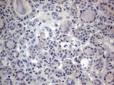 Immunohistochemistry: VSIG3/IGSF11 Antibody (OTI2H1) [NBP2-46046] - Analysis of Carcinoma of Human thyroid tissue.