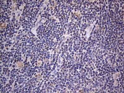 Immunohistochemistry: VSIG3/IGSF11 Antibody (OTI2H1) [NBP2-46046] - Analysis of Human lymphoma tissue.