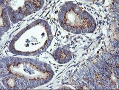 Immunohistochemistry: VTI1A Antibody (1F4) [NBP2-45413] - Analysis of Carcinoma of Human pancreas tissue. (Heat-induced epitope retrieval by 10mM citric buffer, pH6.0, 120C for 3min)